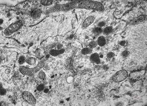 F, 49y. | myelosarcoma … histiocyte-like cells in dermal infiltrates